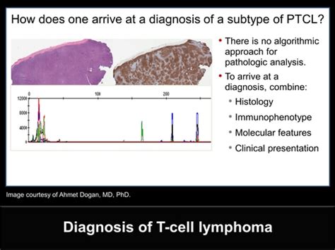 cappelli lv|Peripheral T cell lymphomas: from the bench to the clinic.